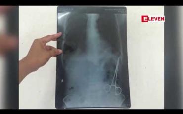 Embedded thumbnail for ခွဲစိတ်ခန်းသုံးကိရိယာ ဝမ်းဗိုက်ထဲကျန်ခဲ့သဖြင့် ပေါ့ဆစွာခွဲစိတ်ခဲ့သည့်ဆရာဝန်ကိုအရေးယူပေးရန် တိုင်ကြားမှု လေးလကျော် ကြာသည်အထိ ဖြေရှင်းဆောင်ရွက်ပေးမှုမရှိသေးဟု မိသားစုဝင်များပြော 