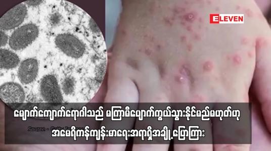 Embedded thumbnail for မျောက်ကျောက်ရောဂါသည် မကြာမီပျောက်ကွယ်သွားနိုင်မည်မဟုတ်ဟု အမေရိကန်ကျန်းမာရေးအရာရှိအချို့ ပြောကြား