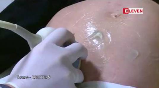 Embedded thumbnail for အမေရိကန်တွင် ကိုယ်ဝန်ဖျက်ချမှုတားမြစ်ရေး ဥပဒေမူကြမ်းကို အတည်ပြုလိုက်သည့်ပြည်နယ်များထဲ မစ်ဆူရီပြည်နယ် နောက်ဆုံးပါဝင်လာ 
