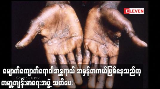 Embedded thumbnail for ၂၉ နိုင်ငံ၌ ကူးစက်ခံရသူ ၁,၀၀၀ ကျော်ရှိလာချိန်တွင် မျောက်ကျောက်ကူးစက်ရောဂါ