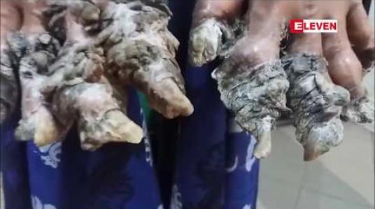Embedded thumbnail for ဘင်္ဂလားဒေ့ရှ်သစ်ပင်လူသား အခြေအနေဆိုးရွားလာ၍ ဆေးရုံပြန်တက်ခဲ့ရ 
