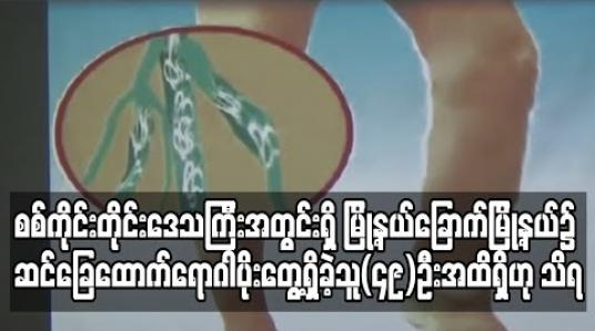 Embedded thumbnail for စစ်ကိုင်းတိုင်းဒေသကြီးအတွင်းရှိ မြို့နယ်ခြောက်မြို့နယ်၌ ဆင်ခြေထောက်ရောဂါပိုးတွေ့ရှိခဲ့သူ(၄၉)ဦးအထိရှိဟုသိရ (ရုပ်သံ)