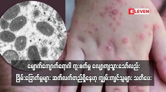 Embedded thumbnail for မျောက်ကျောက်ရောဂါ ကူးစက်မှု လျော့ကျသွားသော်လည်း ခြိမ်းခြောက်မှုများ ဆက်လက်တည်ရှိနေ