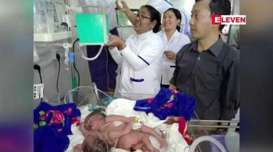 Embedded thumbnail for ကလေးမြို့တွင် မွေးဖွားခဲ့သော ရင်ချင်းဆက်အမွှာ မိန်းကလေးနှစ်ဦး မွေးဖွားပြီး နာရီ ၄၀ ခန့်အကြာတွင် သေဆုံး 