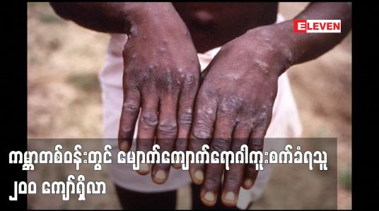 Embedded thumbnail for ကမ္ဘာတစ်ဝန်းတွင် မျောက်ကျောက်ရောဂါကူးစက်ခံရသူ ၂၀၀ ကျော်ရှိလာ